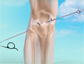 Knee Arthroscopy - Prof. Gautam Chakrabarty - Consultant Orthopaedic Surgeon